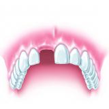 zu versorgende Zahnlücke