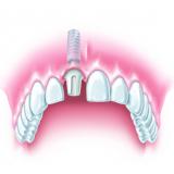 Implantat mit Titanaufbau