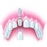 Krone wird auf Titanaufbau montiert